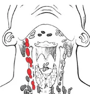 Laryngeal & Hypopharyngeal Cancer- Dr.Amit Chakraborty