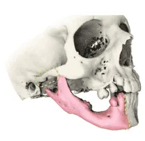 Mandicular Reconstruction- Dr.Amit Chakraborty