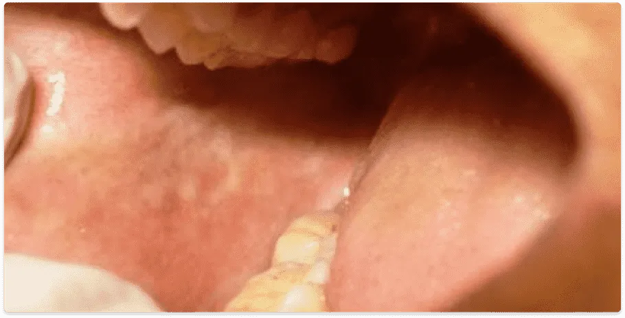 buccal mucosa cancer treatment- dr. amit chakraborty