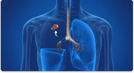 Lobectomy -Purposes of Thyroid Surgery- Dr.Amit Chakraborty