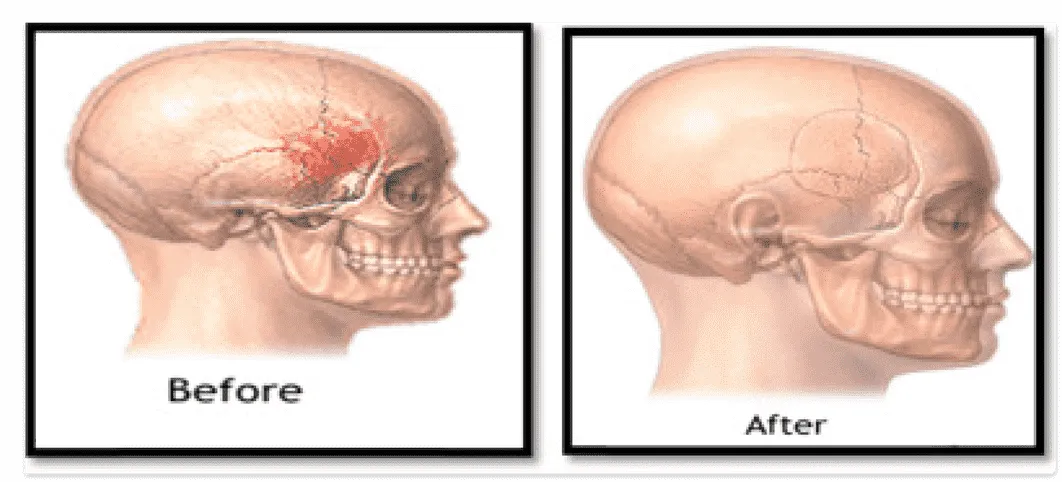 Mandibular Reconstruction Dr Amit Chakraborty