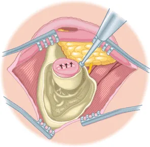 Superficial Parotidectomy