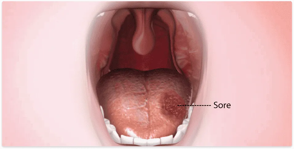 Tongue Cancer Treatment- Dr.Amit Chakraborty