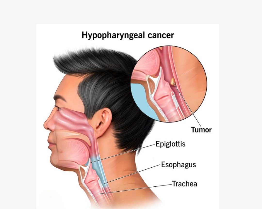 Surgical Management of Hypopharyngeal Cancer: Dr. Amit Cancer Care