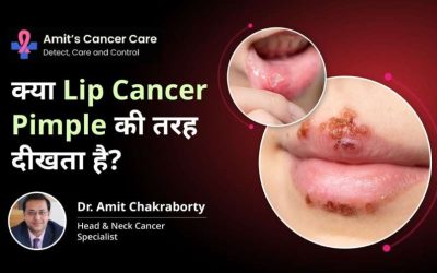 lip cancer signs video- Dr.Amit Cancer Care