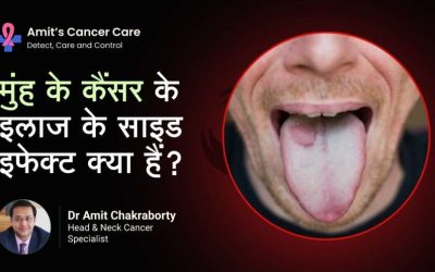 Side effects of Mouth Cancer- Dr.Amit Cancer Care