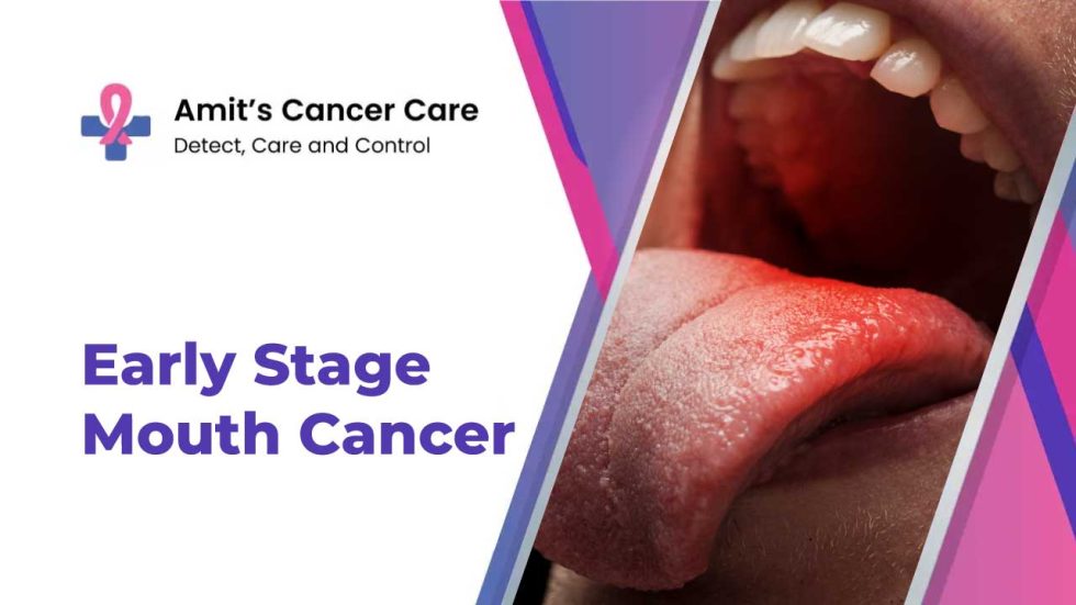 Early Stage of Mouth Cancer