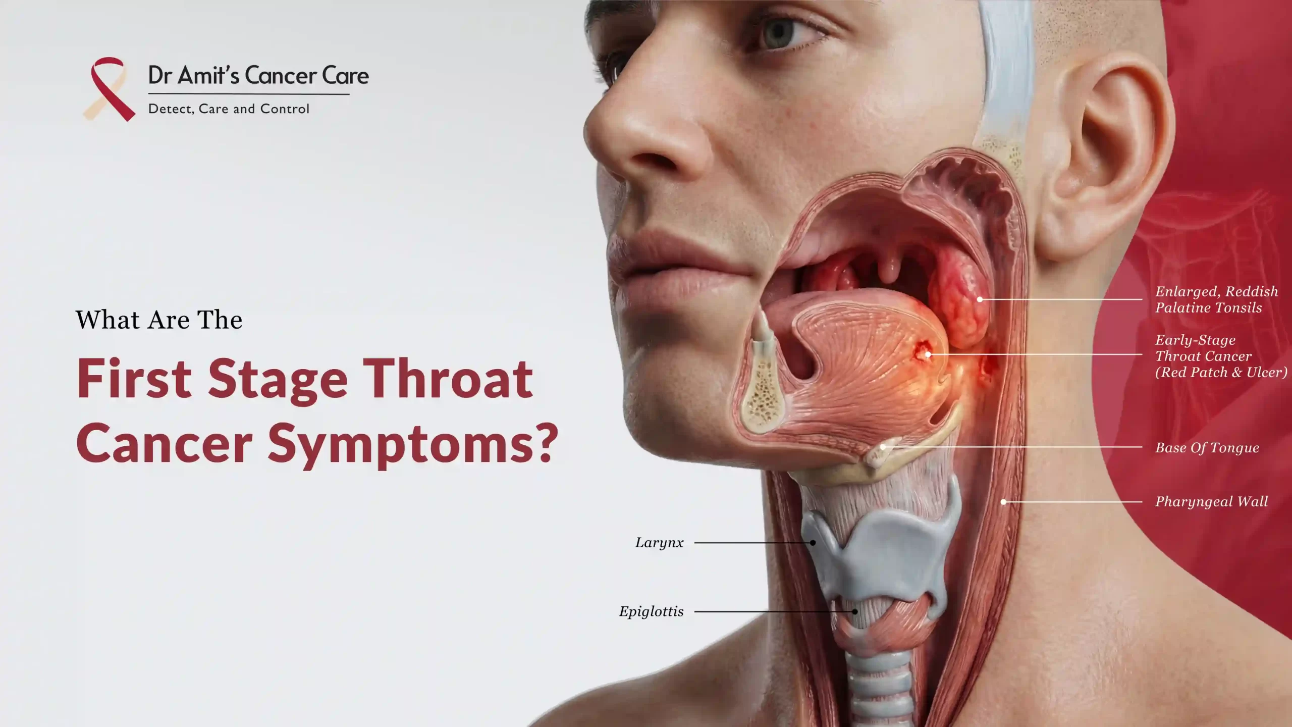 What are the First Stage Throat Cancer Symptoms?