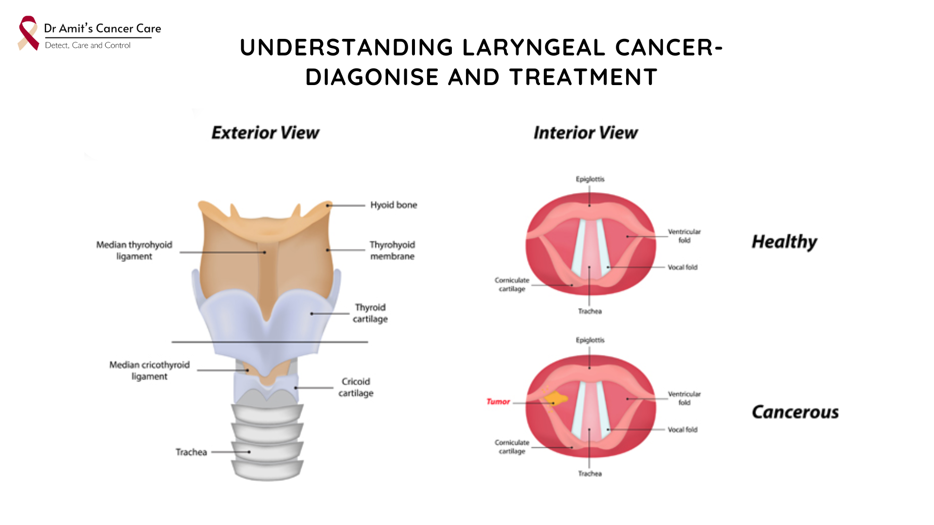 Diagnosing & Treating Laryngeal Cancer