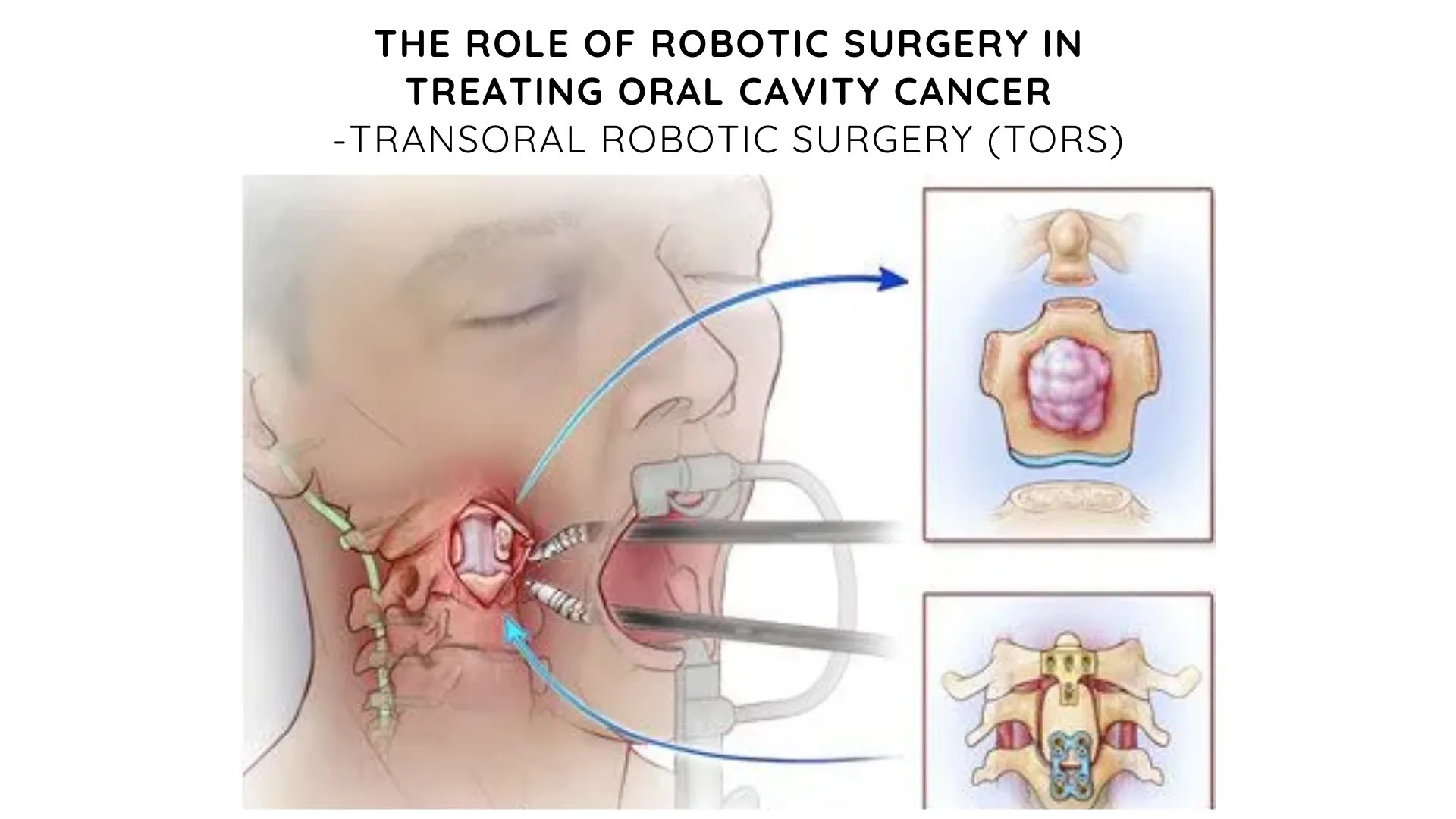 Robotic Surgery for Oral Cavity Cancer