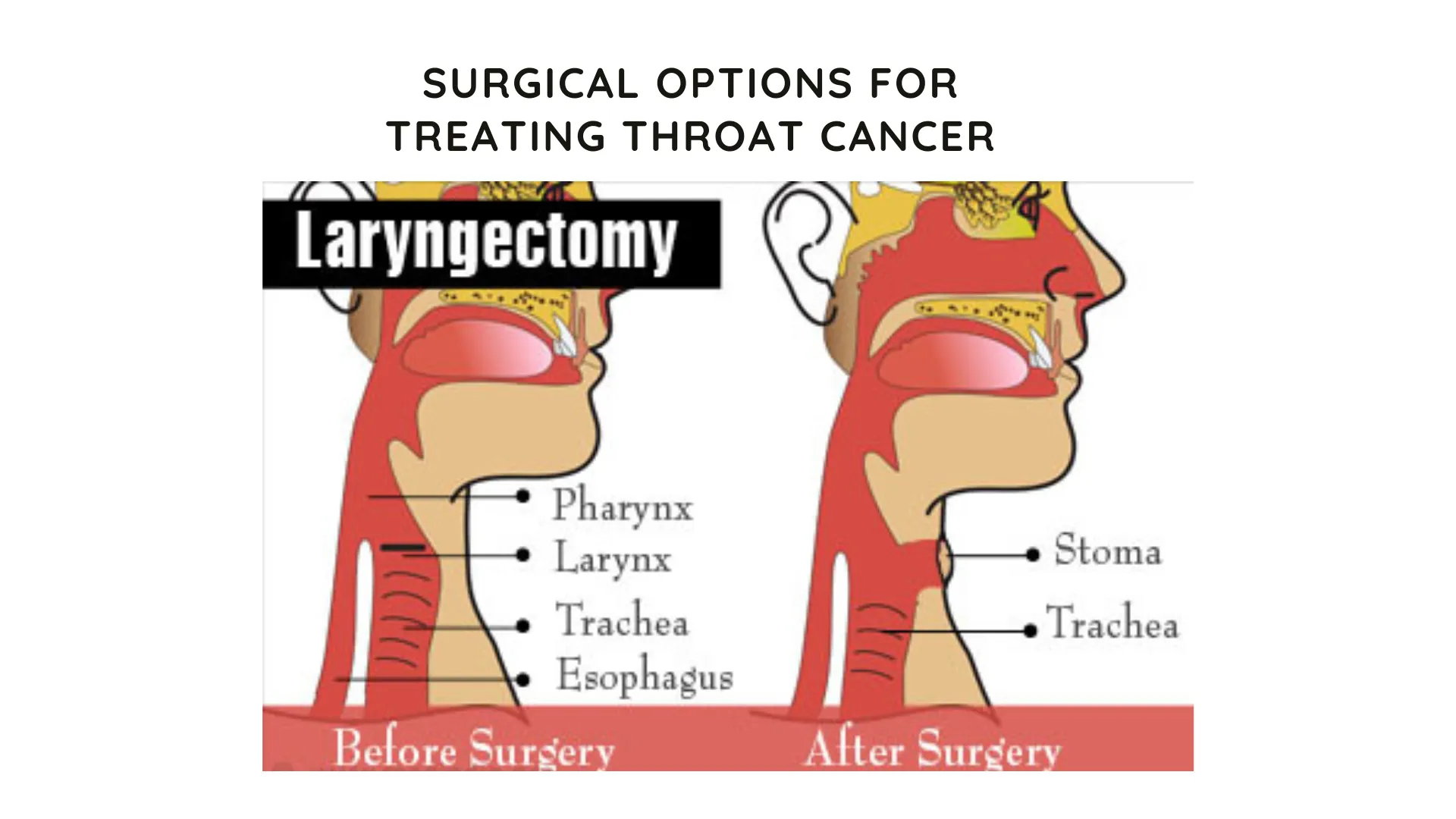 Surgical Options for Throat Cancer