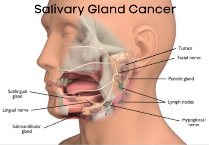 Advanced Techniques for Salivary Gland Cancer