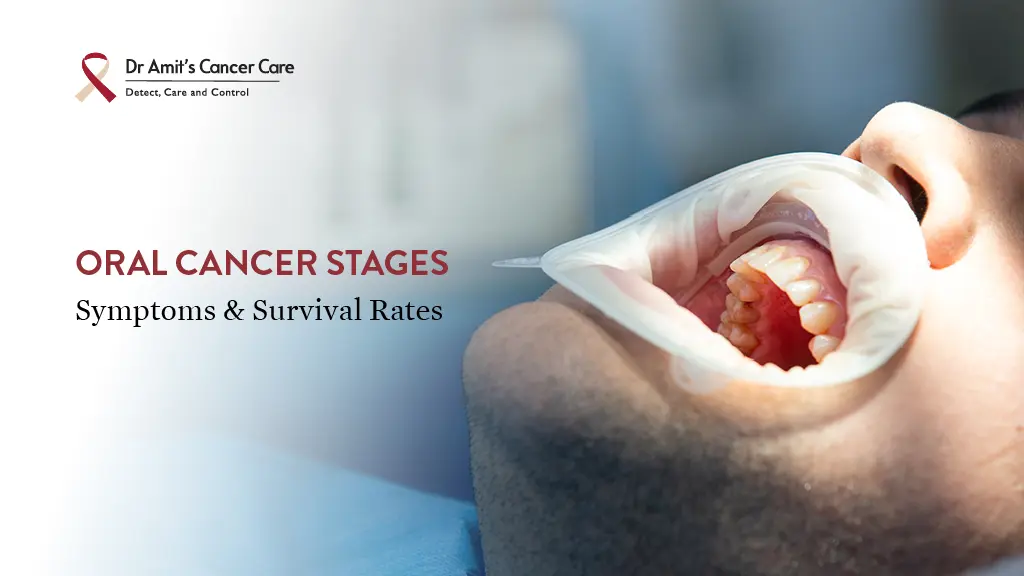 Oral Cancer Stages: Symptoms and Survival Rates