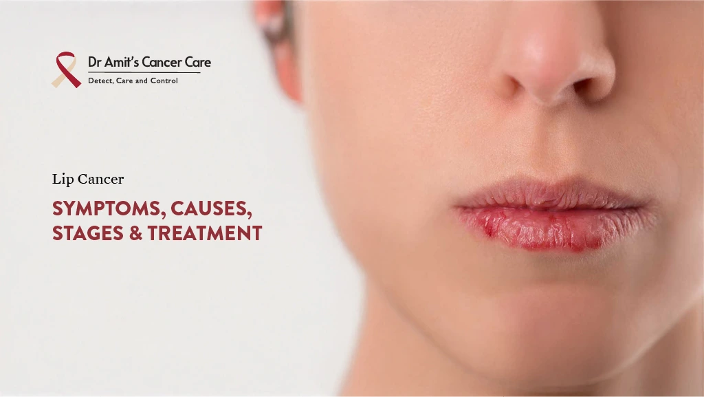 Lip Cancer: Symptoms, Causes, Stages and Treatment