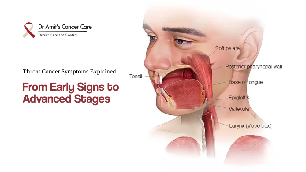 Throat Cancer Symptoms Explained From Early Signs To Advanced Stages