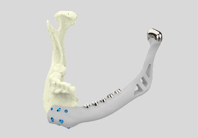 What is Mandibular Reconstruction?