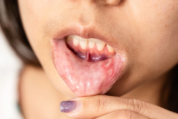 What is Oral Cancer?