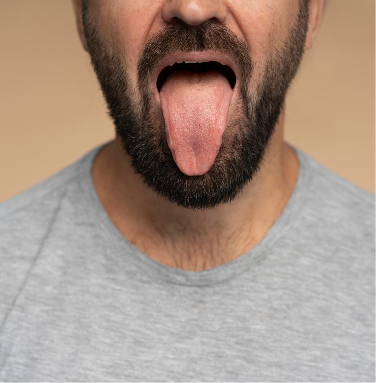What are the Symptoms of Tongue Cancer?