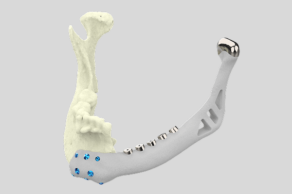 What is Mandibular Reconstruction?