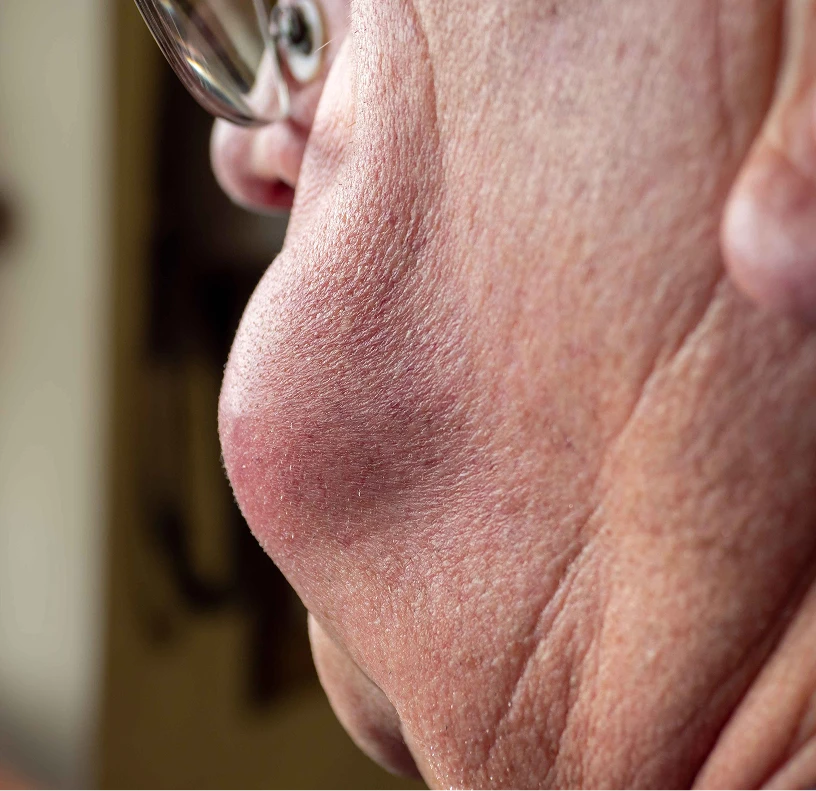 Who Is the Ideal Candidate for Buccal Mucosa Cancer Treatment?