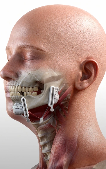 Mandibular Reconstruction Plate