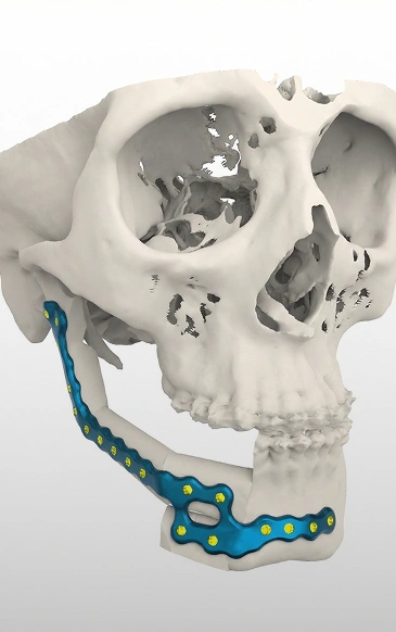 Fibula Free Flap or Free Fibular Graft