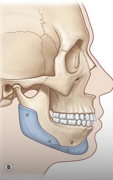 Alloplastic Implants and Plates