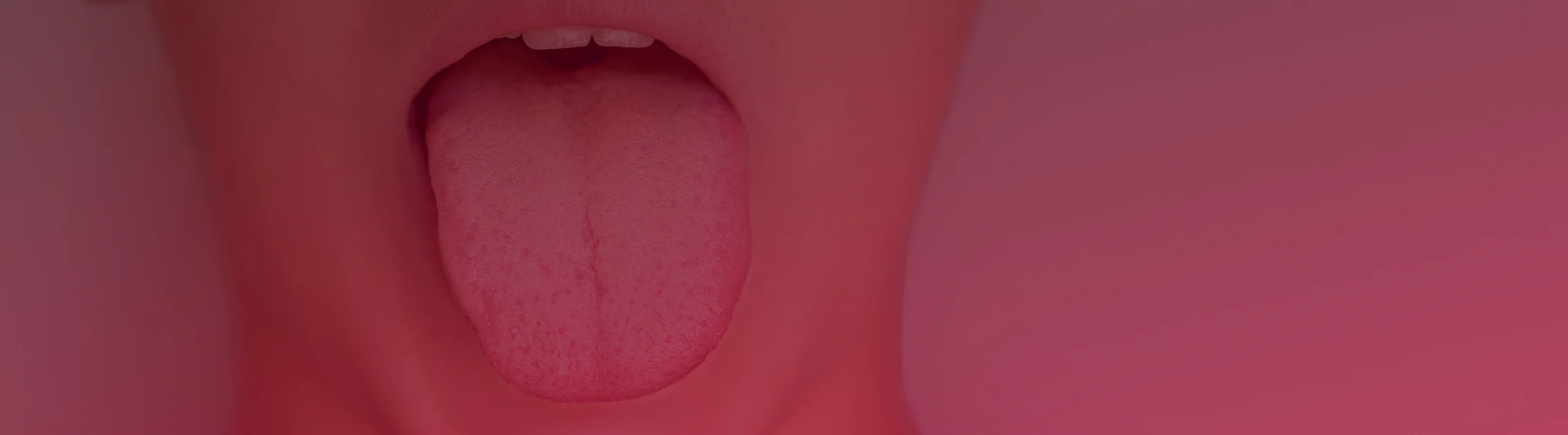 Tongue Cancer