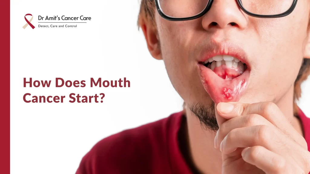 how does mouth cancer start