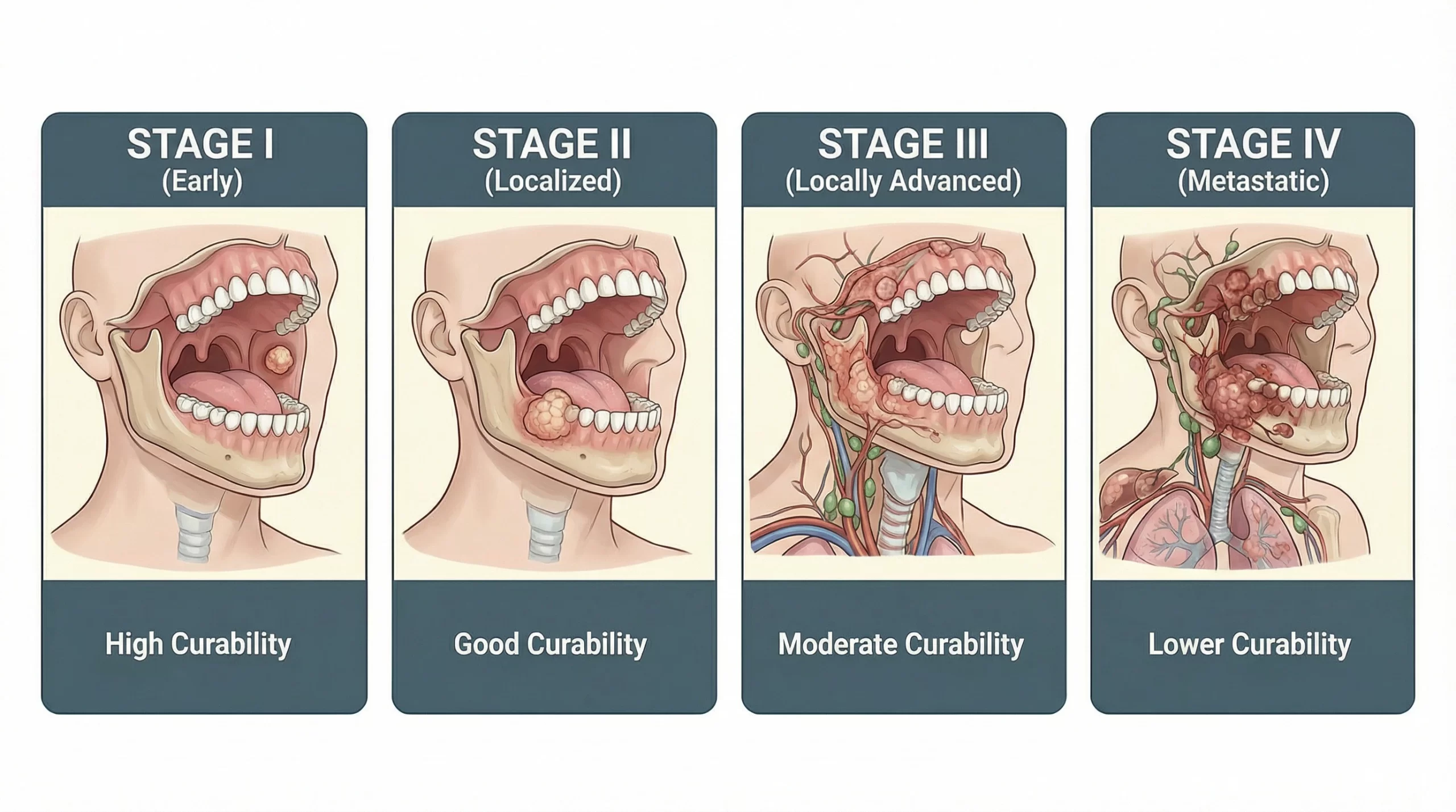 How Curable Is Mouth Cancer by Stage