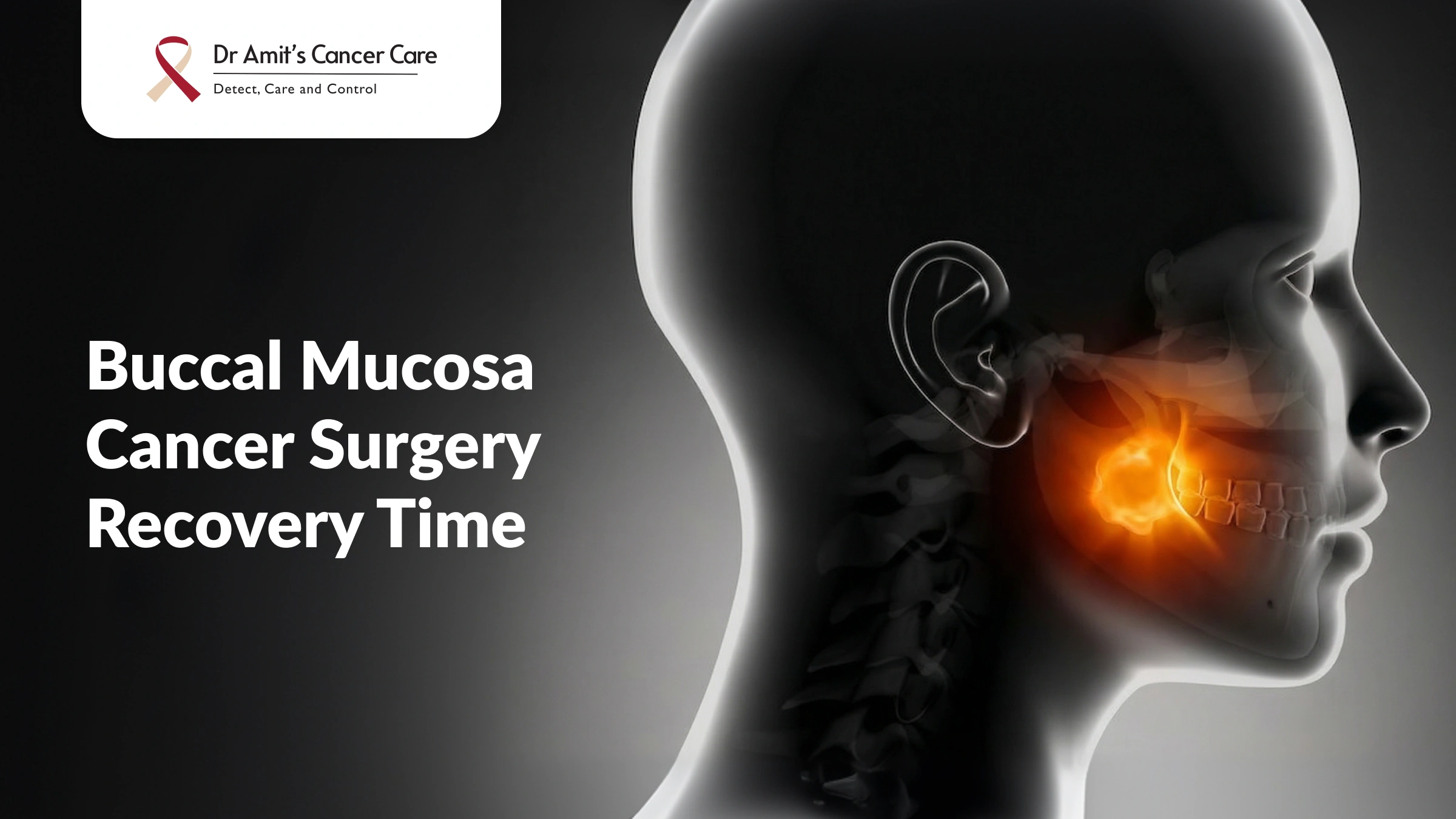 Buccal Mucosa Cancer Surgery Recovery Time: What to Expect After Treatment?
