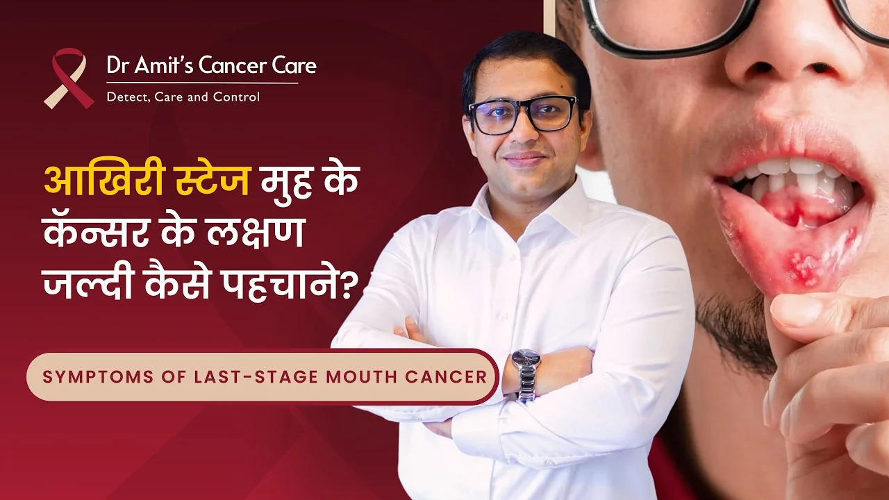 आखरी स्टेज मुह के कॅन्सर के लक्षण ? | Last Stage Oral Cancer Symptoms | Dr. Amit