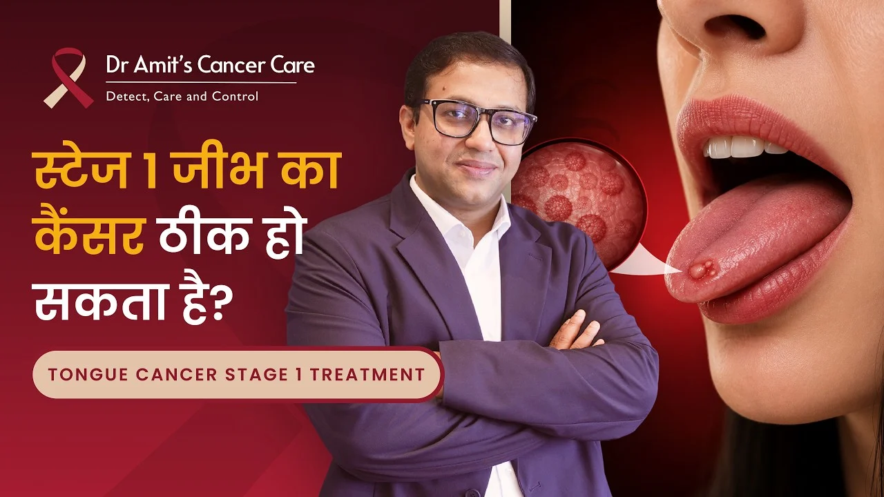 स्टेज 1 जीभ का कैंसर ठीक हो सकता है या नहीं? | Is Stage 1 Tongue Cancer Curable?