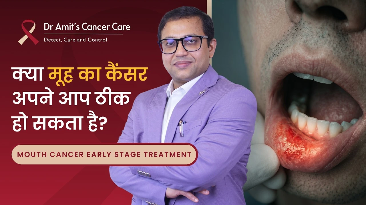 क्या मूह का कैंसर अपने आप ठीक हो सकता है? | Do Mouth cancer get cured on its own?