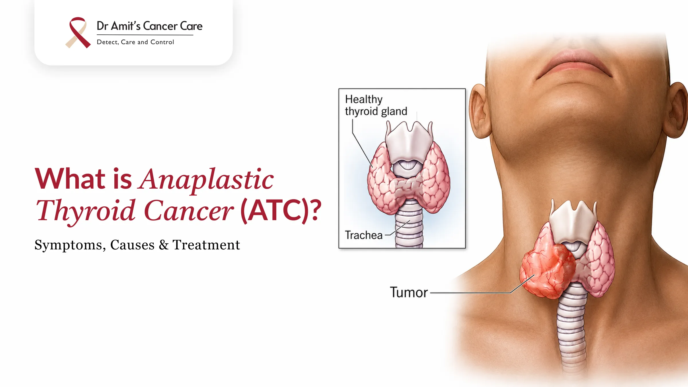 What is Anaplastic Thyroid Cancer (ATC)? Symptoms, Causes & Treatment
